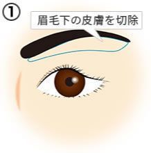 画像:眉毛下皮膚切除の流れ (1)