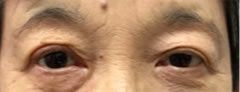 画像:眼瞼下垂手術 抜糸時