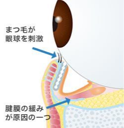 画像:下眼瞼内反手術(2)