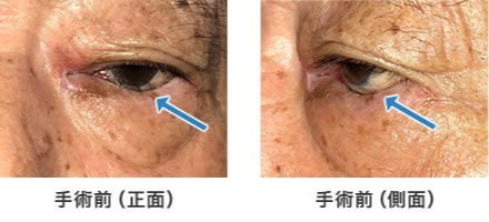 画像:下眼瞼内反手術 手術前