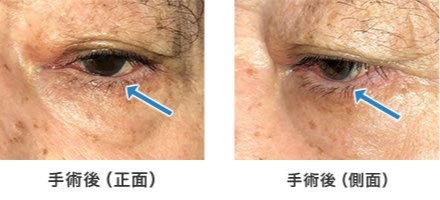 画像:下眼瞼内反手術 手術後