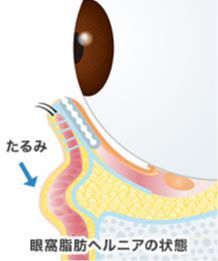 画像:眼窩脂肪除去(1)