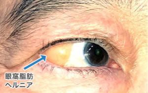 画像:眼窩脂肪が眼球側に突出している症例 手術前