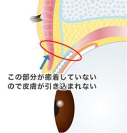 画像:二重の手術の仕組み(1)