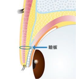 画像:二重の手術の仕組み(2)