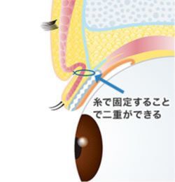 画像:二重の手術の仕組み(3)