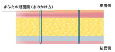画像:一般的な二重の手術(2)