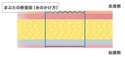画像:当院の二重の手術(2)