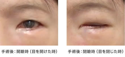 画像:症例 顔面神経麻痺による眼症状に対する手術(2)