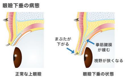 画像:眼瞼下垂の病態