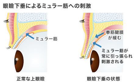 画像:眼瞼下垂によるミュラー筋への刺激