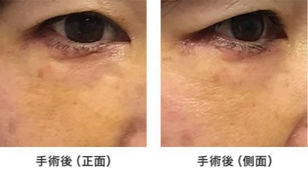 画像:症例(下まぶたのたるみ)手術後