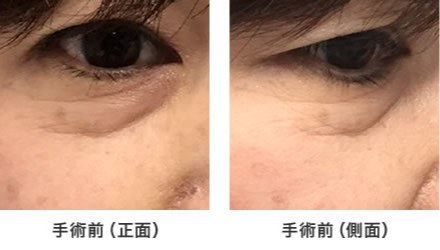 画像:症例(下まぶたのたるみ)手術前