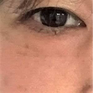 画像:症例(下まぶたのたるみ)手術後1ヶ月