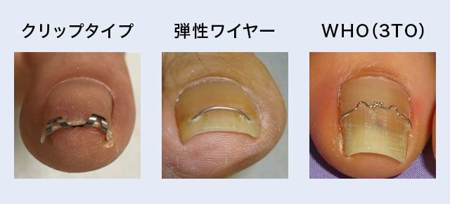 画像:矯正タイプ
