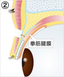 画像:挙筋腱膜前転術の流れ(2)